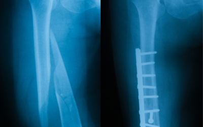 Understanding the Causes and Consequences of Bone Fractures