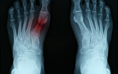 A Closer Look at Bone Fracture Injuries